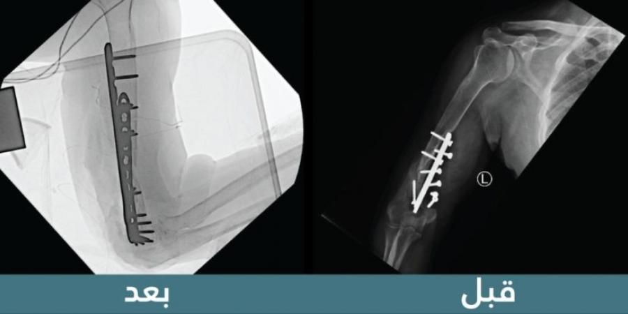 "سعود الطبية" تنهي معاناة استمرت 19 عامًا لمريض فقد حركة الكوع - تدوينة الإخباري