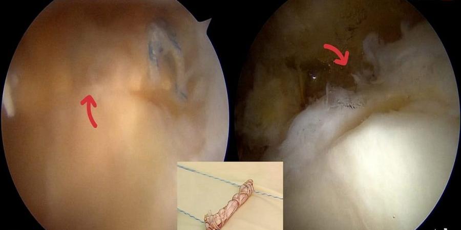 مجمع الدكتور سليمان الحبيب بالعليا يُجري عملية معقدة لبناء غضروف الورك لعشرينية وينهي معاناة استمرت 7 سنوات - تدوينة الإخباري