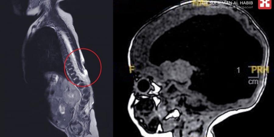 مستشفى الدكتور سليمان الحبيب بالقصيم يُجري بنجاح عمليةً معقدة بالعمود الفقري لإنقاذ رضيع من تَبِعَات تشوه خلقي - تدوينة الإخباري